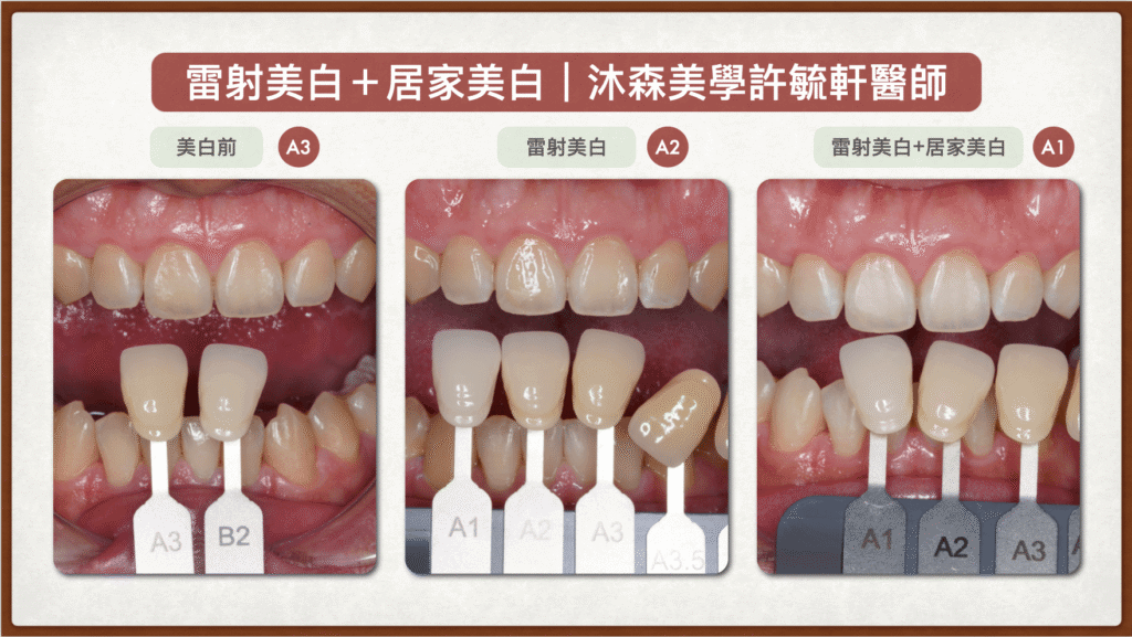 牙齒美白