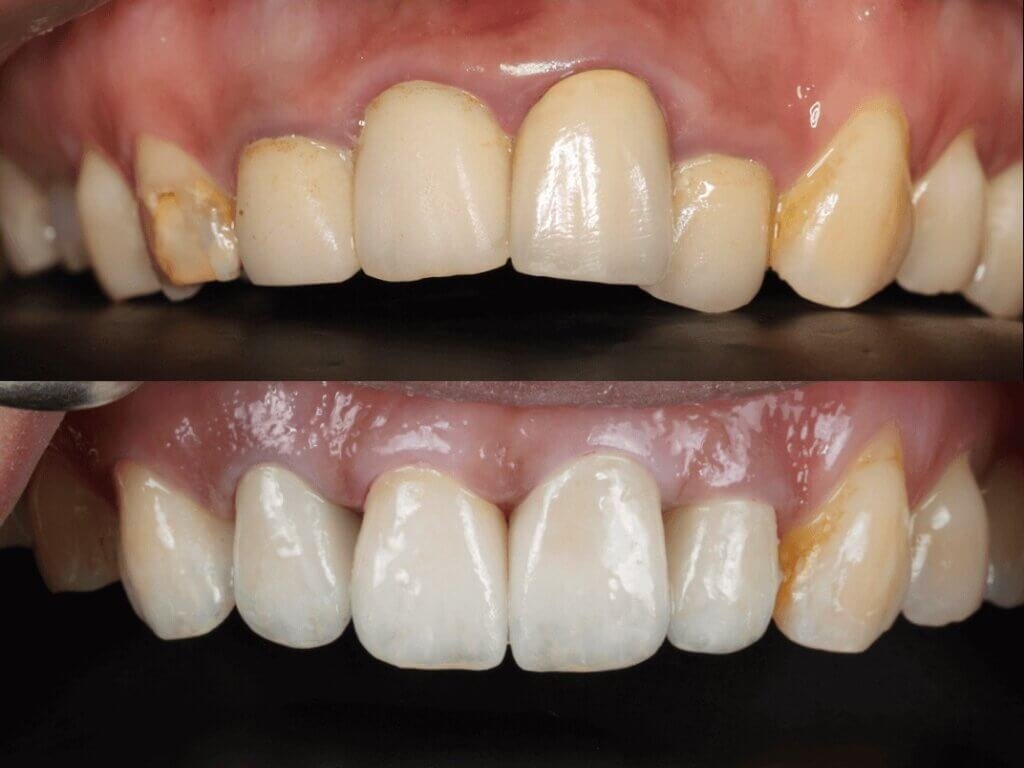 前牙全瓷冠術前術後對比-改善牙齦發黑與牙齒型態-嘉義民雄沐森美學牙醫案例