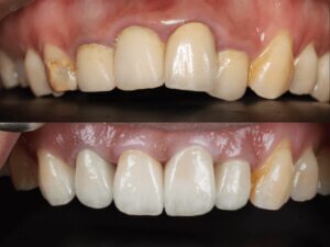 前牙全瓷冠術前術後對比-改善牙齦發黑與牙齒型態-嘉義民雄沐森美學牙醫案例