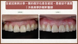 嘉義民雄全瓷冠推薦-許毓軒醫師前牙美學案例-全瓷冠重做改善死白