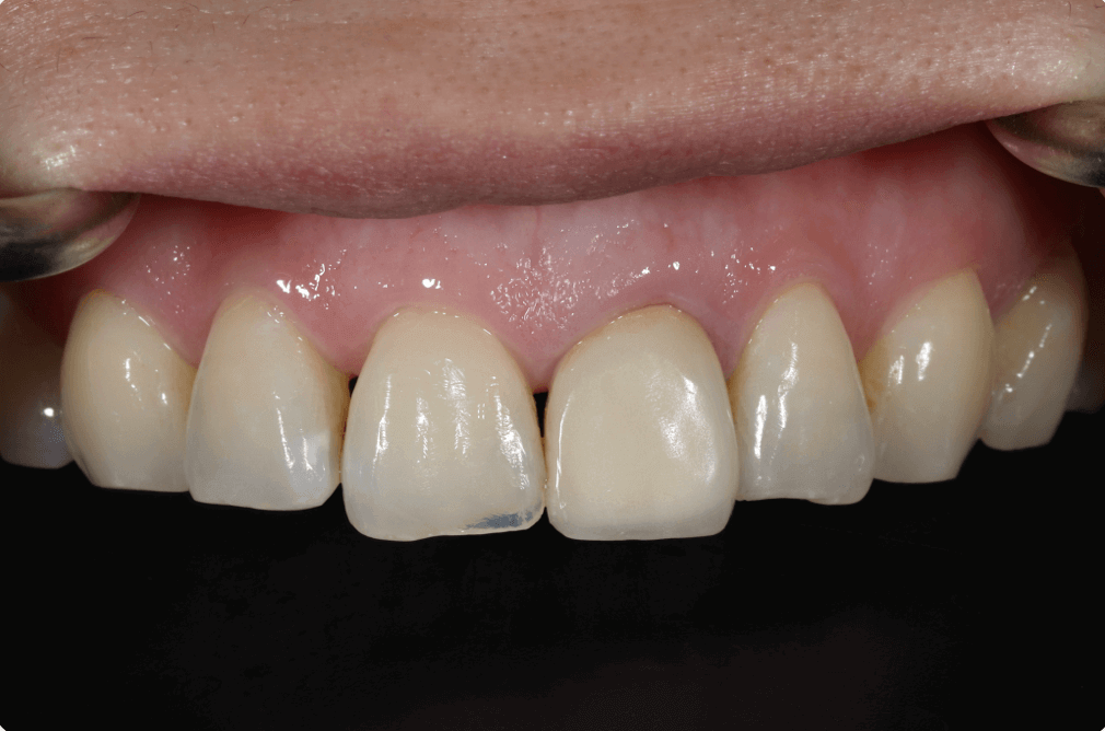 不好看的全瓷冠