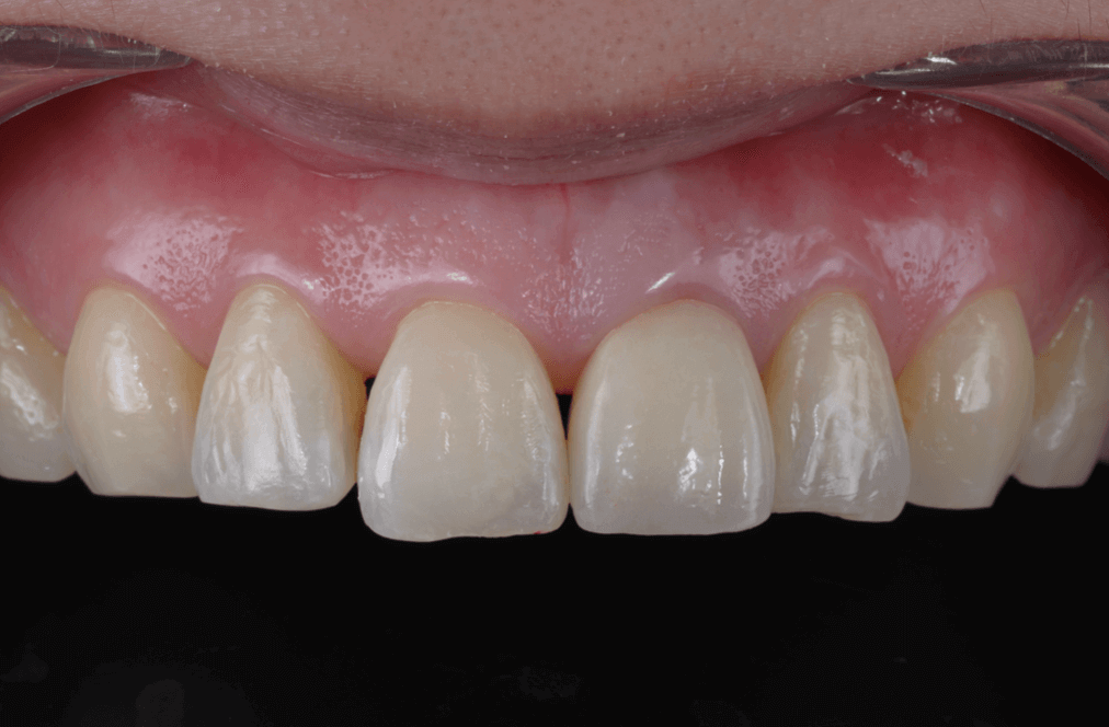 全瓷冠自然透感