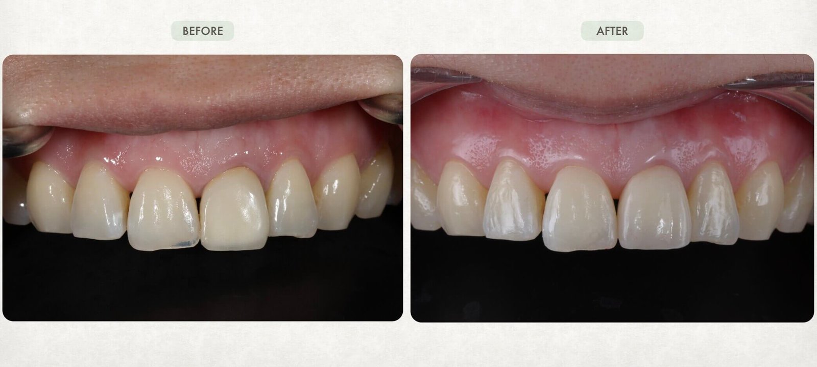 嘉義民雄全瓷冠推薦-許毓軒醫師全瓷冠重做案例