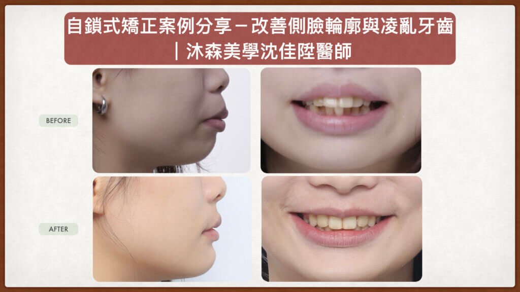 沈佳陞醫師自鎖式矯正案例_改善側臉輪廓與嘴凸