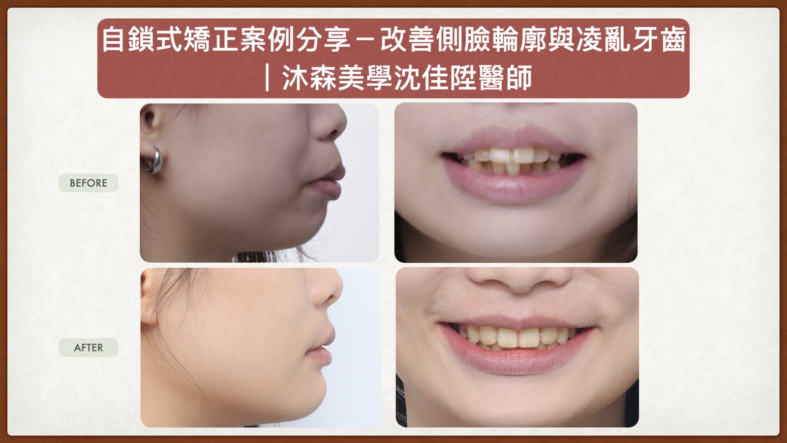 沈佳陞醫師自鎖式矯正案例_改善側臉輪廓與嘴凸