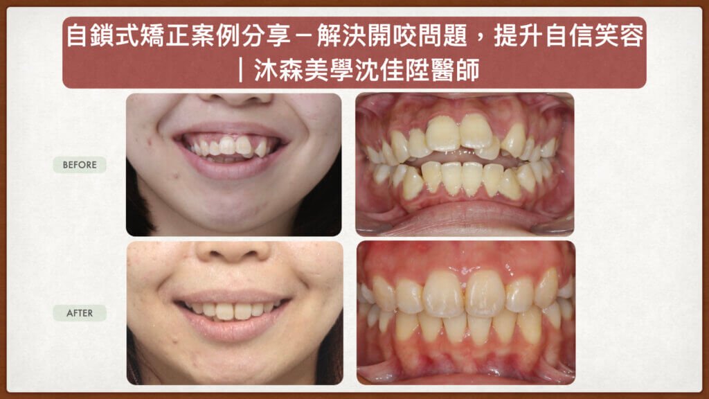 沈佳陞醫師開咬矯正案例_自鎖式矯正解決前牙開咬