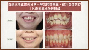 沈佳陞醫師開咬矯正案例_自鎖式矯正解決前牙開咬