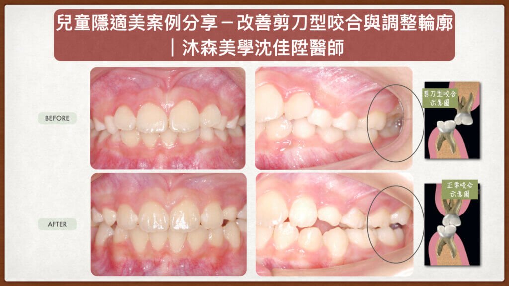 兒童隱適美矯正前後對比，沈佳陞醫師改善剪刀型咬合問題